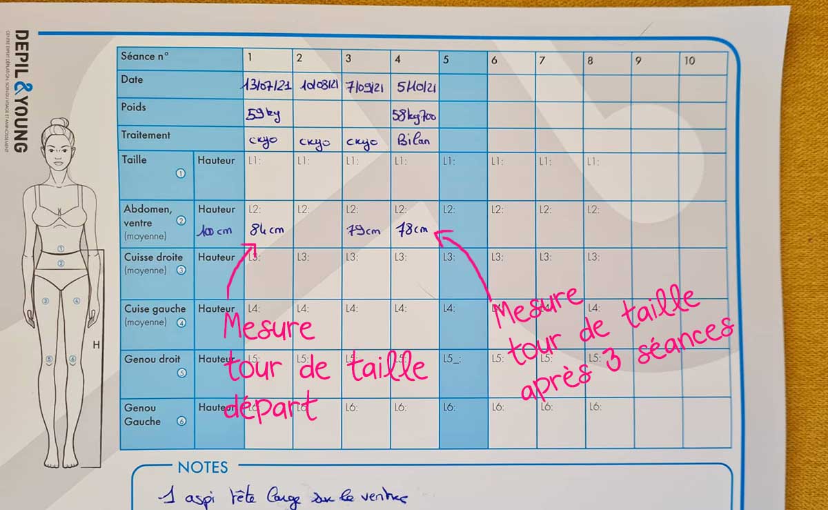 resultat-cryolipolyse